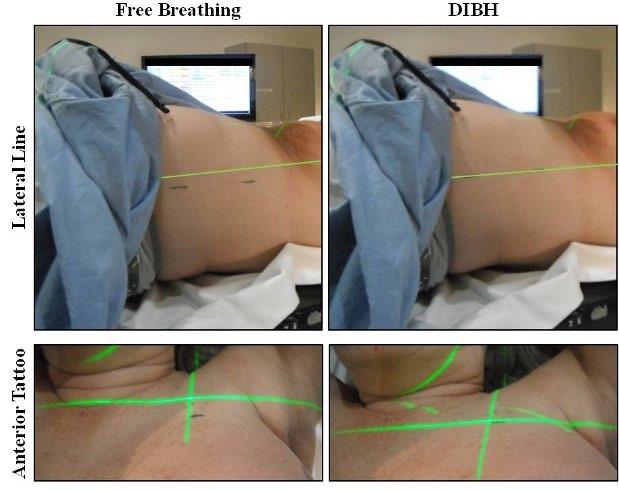 Visually monitored DIBH setup technique: (a) free-breathing; (b) DIBH. Lateral lasers in the photo have been enhanced to improve visibility. Fig. 2.