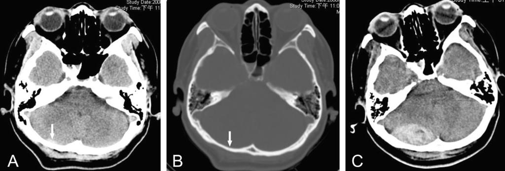 Tsung-Ming Su, et al 276 Fig. 1 (A) Computed tomography (CT) scan shows a thin layer of intracranial hematoma in the posterior fossa (arrow), with a skull fracture (B) in the occipital region (arrow).
