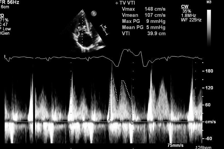 Mean TV Gradient: 5 mmhg (HR-=126 bpm) Journal of Thoracic and(j Thorac Cardiovasc Surg 2014;148:3042-8) 12 surgeons performed 19 TV