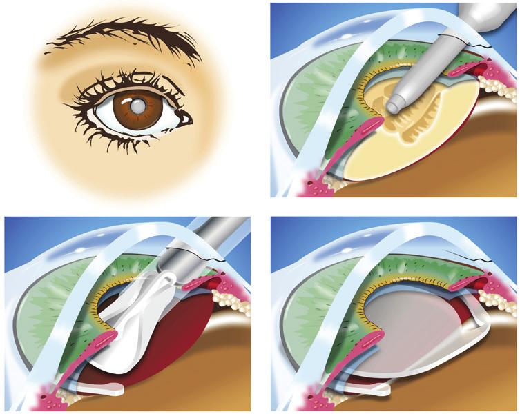 Finding a Cataract Surgeon What percentage of your patients experience eye infections? Has your center ever had an outbreak of eye infections?
