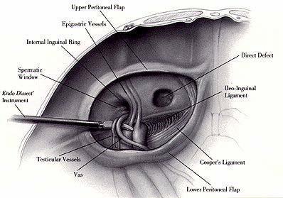 Figure 2: Laproscopic anatomy of inguinal canal IR Internal Ring E R External Ring IC Inguinal Canal C S Cord Structure IEV Inferior
