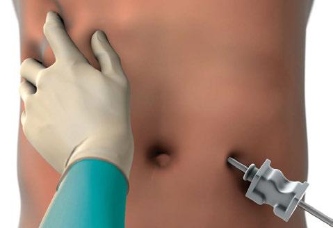 3 4 For fixation, counter pressure should be applied on the skin of the abdominal wall.
