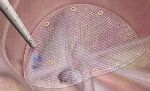 Laparoscopic Inguinal Hernia Repair Using 3DMax Light Mesh 1 2 In laparoscopic inguinal hernia repair procedures, CapSure Permanent fasteners may be used to fixate mesh, such as 3DMax Light Mesh.
