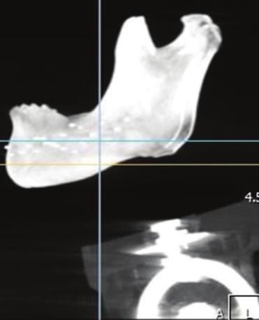 4 BioMed Research International Before correction (a) After correction measurements between the 0-degree angle and the other angles in all sites of the mandible.