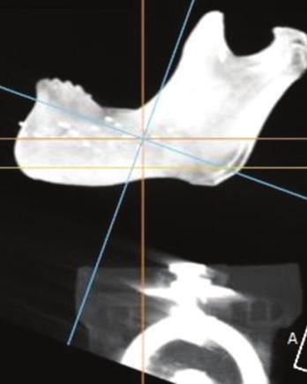 In conclusion, changes of mandibular position in CBCT scan affected the vertical measurements from the crosssectional images according to the sites of the mandible.