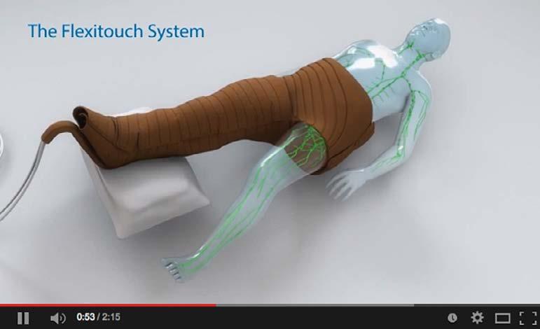 1,4 Flexitouch has achieved significant results for patients with lymphedema and non-healing wounds.