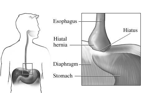 hiatus Symptoms: Dysphagia Chest pain Heartburn Belching Regurgitation Paraesophageal Hiatal Hernia Fundus and
