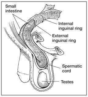 Types of Abdominal Hernias Indirect inguinal Direct inguinal Femoral Umbilical Incisional Indirect Inguinal Hernia Peritoneal sac w intestine