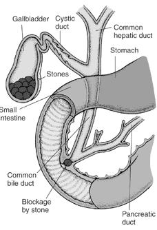 Cholelithiasis - patho Gallstones Abnormal bile composition Biliary stasis Increased cholesterol inflammation Manifestation Mild distress Biliary colic w obstruction Cholecystitis Acute or chronic