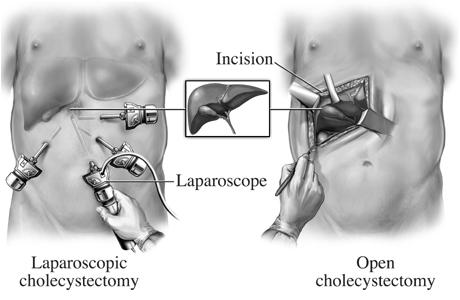 Cholecystitis surgical Management (cont) Cholecystectomy Traditional cholecystectoy Removes gallbladder and stones 4-6 inch incision made into the abdomen Usually home in 1-3 days Back to work in 4-6