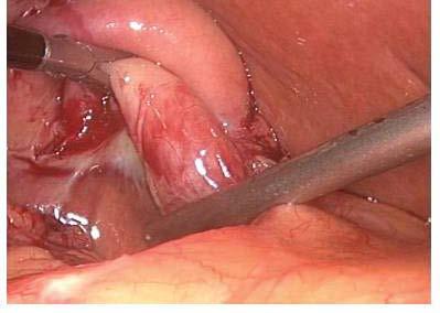 Normal gallbladder