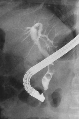 ERCP Cannulation of ampulla Sphincterotomy Removal of stones +/- biliary stent If unsuccessful