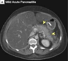 Gallstone Pancreatitis Pancreatic