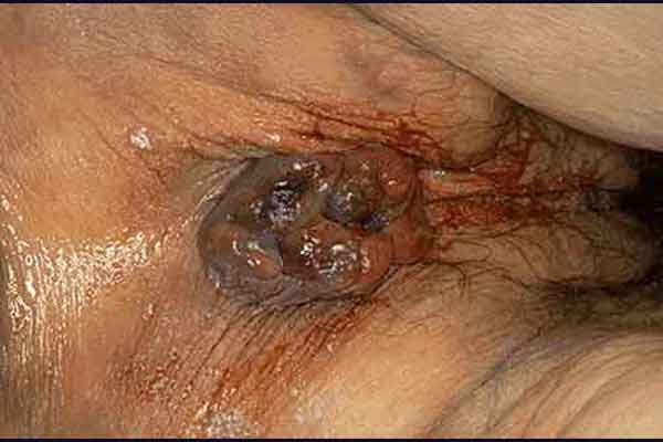 Symptoms Rectal Bleeding Bright red blood in stool Pain during bowel movements Anal Itching Rectal Prolapse Thrombus Gastroenterologists Referral Seek emergency care if : large amounts of rectal