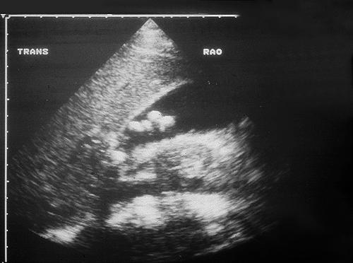 DIAGNOSTIC IMAGING Ultrasound Cholelithiasis 98% specific and >95%
