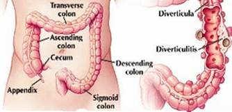 Diverticulitis Diverticulosis Diverticulitis: Outpatient or In?