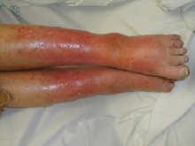 Necrotizing Fasciitis Necrotizing Soft Tissue Infection Pain out of proportion Often very elevated WBC Mixed bacteria but often Group A beta hemolytic strep MUST get timely surgical consultation and