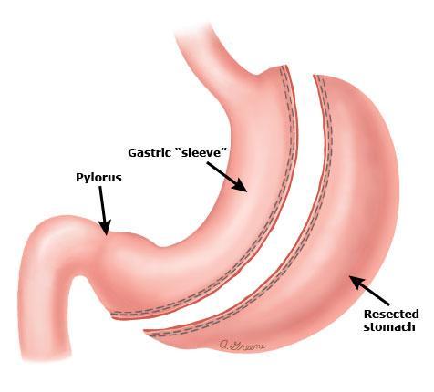 sleeve of stomach Removes large portion of greater curvature Produces a decrease in