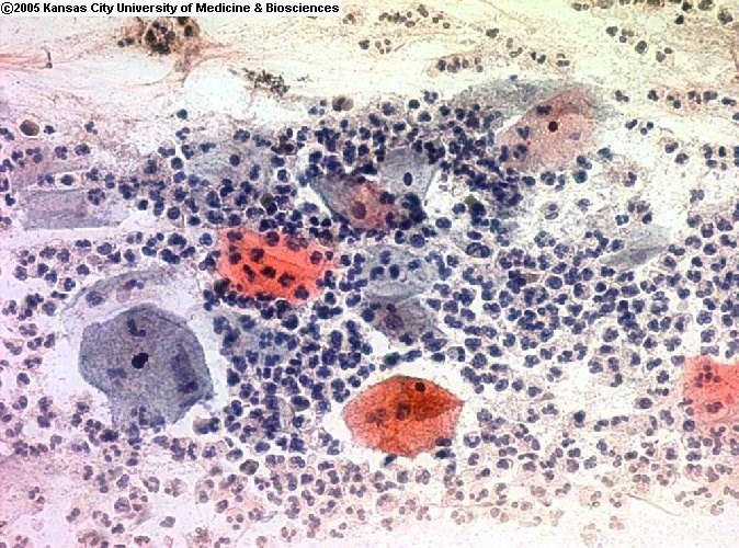 Cervical cytology - Inflammation Interpretation difficult due to