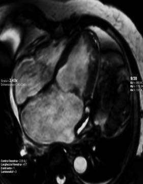 Echo: dilated left ventricle, EF 35%, severe MR, LA 189 ml/mq (395) Normal coronary angio At cardiac MR: