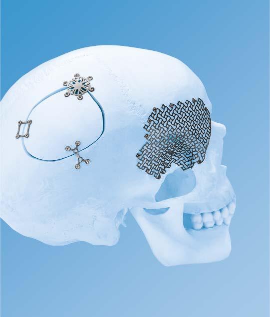 LOW PROFILE NEURO PLATING SYSTEM Introduction The aim of surgical fracture treatment is to reconstruct the bony anatomy and restore its function.