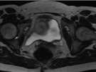 FLEUROSCOPIC EVALUATION Sagging lateral aspect bladder which may be related to defects in endopelvic fascia/muscles Video defecography -