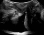 hypermobility and mask SUI Key role of Ultrasound ID position bladder neck / urethra, assess PVR Assess UVJ for rotation and descent -maintain RVA (retrovesical angle > 120 degrees)