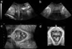 Display Modes : MPR/Rendered Urogenital Diaphragm MPR/orthogonal display mode shows cross-sectional planes through the volume in question (a,b,c) d = standard rendered image of the levator hiatus,