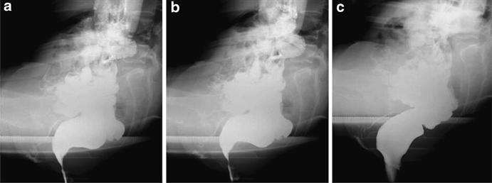 Standard defecography anorectal images at rest ( a ), squeeze ( b ), and evacuation ( c ).