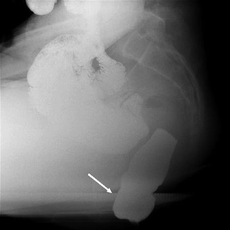 Standard defecography anorectal image demonstrating severe rectal prolapse ( white arrow ) in asymptomatic patients and may not correlate with symptoms of infrequent or incomplete evacuation [ 19, 20