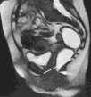 MR - Pubococcygeal line Pelvic Organ Prolapse (Anterior) Pelvic Organ Prolapse (posterior) 3D & Volume Rendered Critical Pelvic