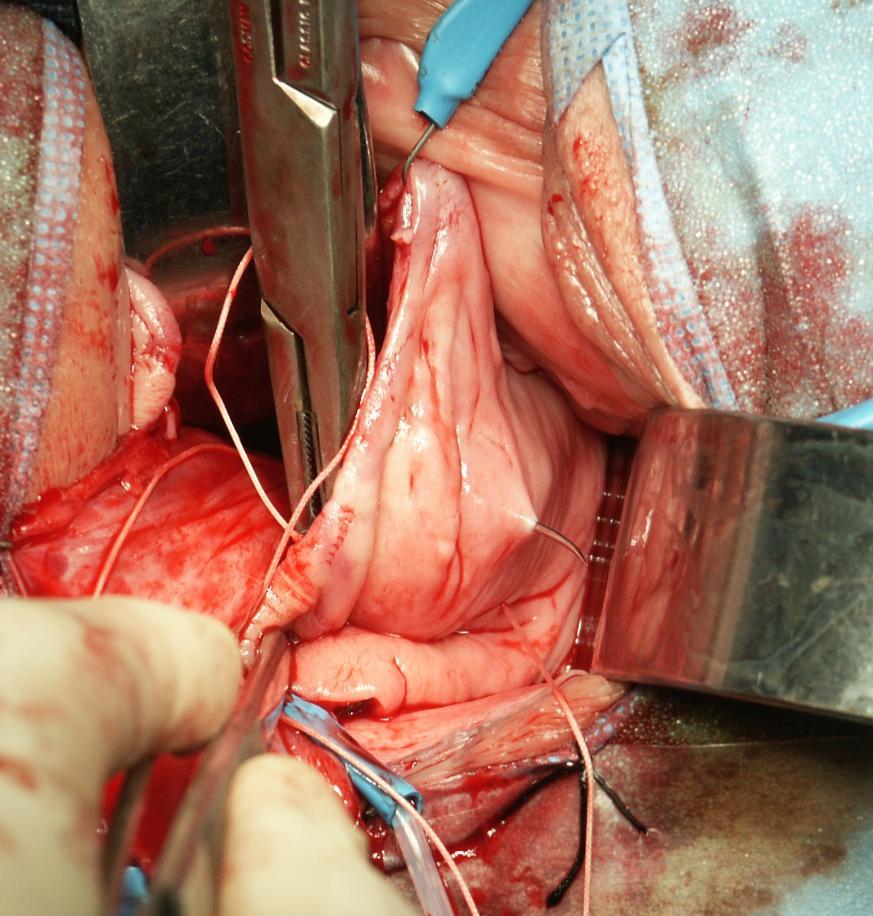 Out of peritoneal sac 1