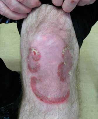Chronic plaque psoriasis Chronic plaque usually causes large red scaly plaques on the elbows and knees. Plaques are also commonly found on the lower back and the scalp.