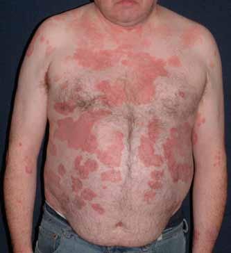 Small plaque psoriasis causes a similar rash but as the name implies the plaques are smaller usually measuring only 2 4 cm in diameter.