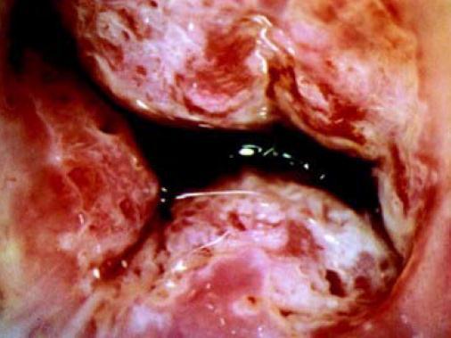 Large Gland or Crypt Openings Associated with excessive mucus, together with other