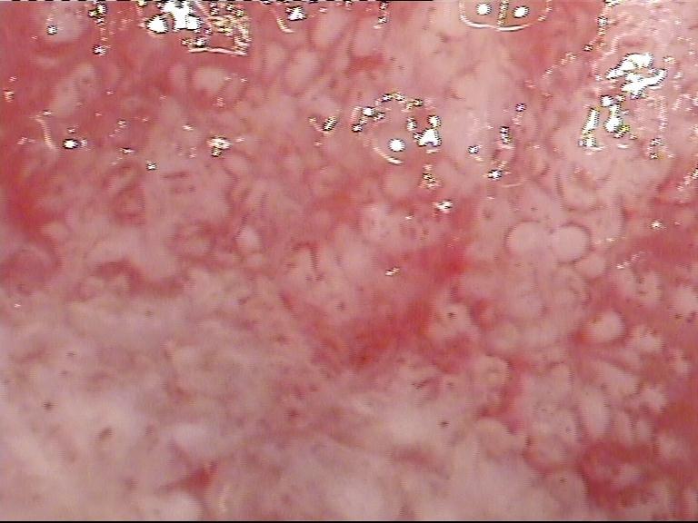 common in squamous lesions, do not