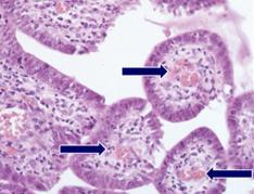 Atypical endocervical cells NOS, ASCUS Formed by vessels