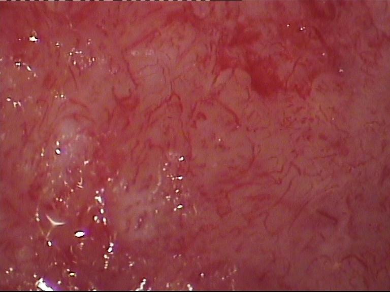 Atypical Vessels Squamous Cell Carcinoma Corkscrew-like
