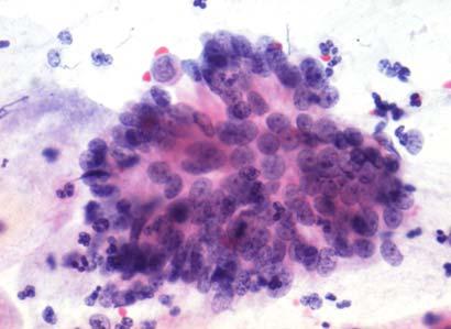 Adenocarcinoma, adenocarcinoma in situ (AIS) and cervical intraepithelial glandular neoplasia (CGIN) AIS