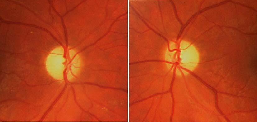 94 Fig. 1. Fundus examination performed 1 month after the visual loss revealed diffuse pallor of both optic discs, OD (right) and OS (left).