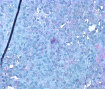 Pathologic examination was consistent with a pituitary adenoma (Figure 2) with immunohistochemical stains strongly positive for synaptophysin and