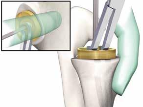 In addition, sharp and blunt retractors are employed around the glenoid, usually with one anteriorly on the scapular neck and one inferiorly at the glenoid neck.