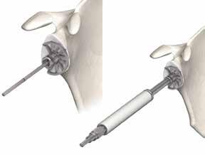 Ream the glenoid fossa Start the reaming with the smallest segmented reamer (Ø30mm). The reamer is applied over the guide wire and placed onto the glenoid.