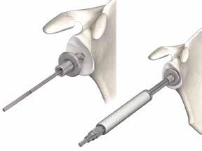 Drill the central anchoring hole for the glenoid base plate Guide the glenoid central reamer with the guide wire. Attach the drive shaft to the reamer.