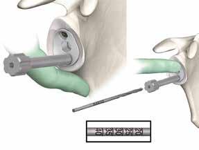Implantation of glenoid bone screws Screw the drill sleeve into the glenoid base plate. Drill the holes for the glenoid bone screws until it perforates the cortical bone.