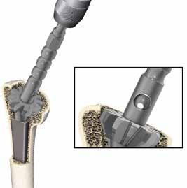 Remove the fixation device by releasing the fixation screw and then extracting the fixation device along the reaming axis.