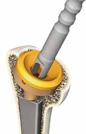 Remove the trial insert with the trial insert extractor. Release the attachment screw of the trial reverse body. Extract the trial reverse body from the humerus.