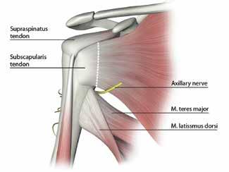 The deltopectoral interval is opened medial to the cephalic vein to preserve venous discharge from the deltoid muscle. The anterior humeral circumflex vessels are exposed and ligated.