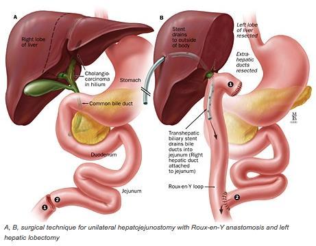 Roux-en-Y hepatojejunostomy to the extrahepatic common hepatic duct