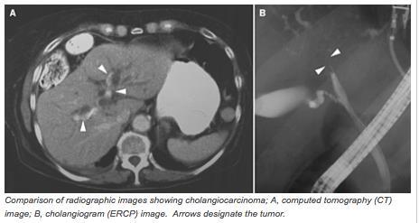 Comparison patients #1 and #2: examples of the radiologic manifestations of cholangiocarcinoma From: Johns Hopkins Medicine.